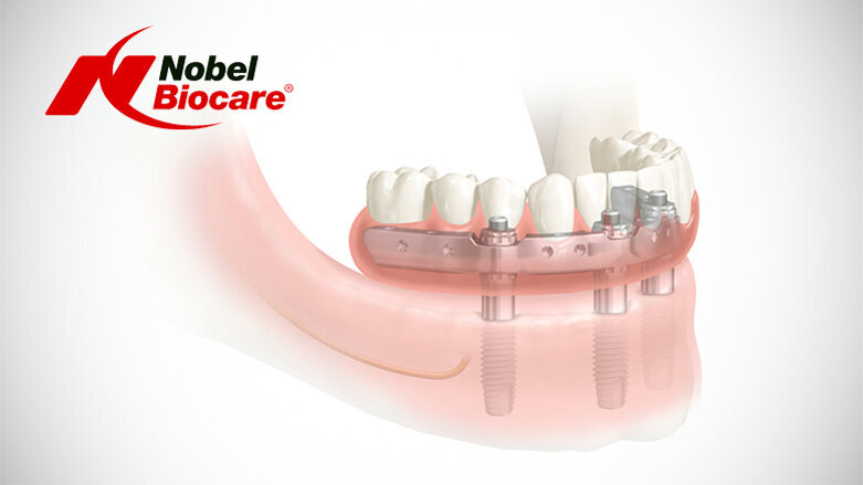 Nobel Biocare demonstrates revolutionary full-arch solution