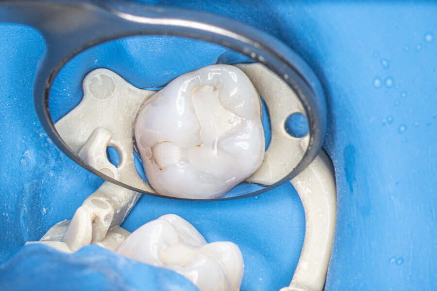 Fig. 38: The maxillary first molar before treatment.