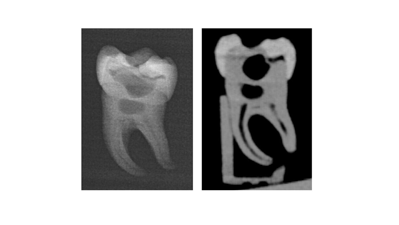 The 3D-printed tooth has realistic properties. Appearance of the tooth in a dental radiograph with all internal structures visible (left), and CBCT image. (Image: Christian Höhne/UKW)