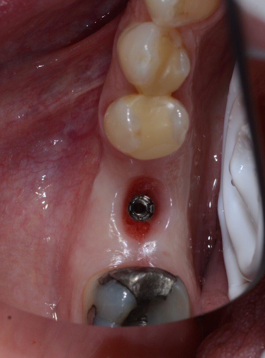 Fig. 8: Favourable soft-tissue healing after six weeks.