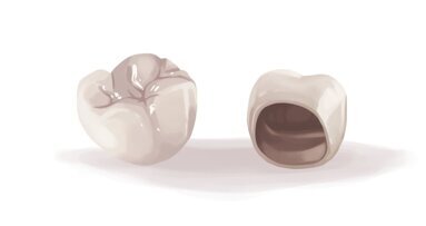 Alumina sandblasting - best method for zirconia surface cleaning & to improve its resin-bond strength