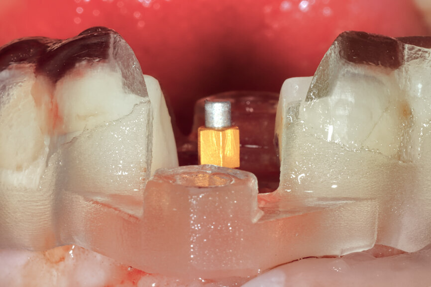 Fig. 25: Using an implant-specific SmartPeg, a baseline ISQ value of 76 confirmed sufficient initial stability to place an immediate restoration.