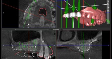 Rigenerazione ossea 3D mediante griglia in titanio CAD/CAM customizzata e chirurgia computer guidata per la riabilitazione di un grave difetto osseo localizzato