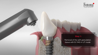 TwinLight Peri-implantitis Treatment