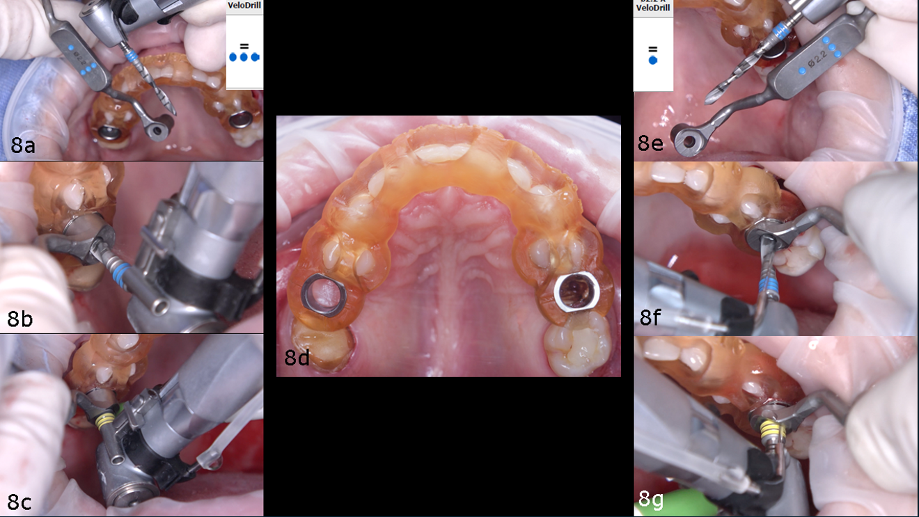 Figs. 8a–g: Guided surgery in both sites.