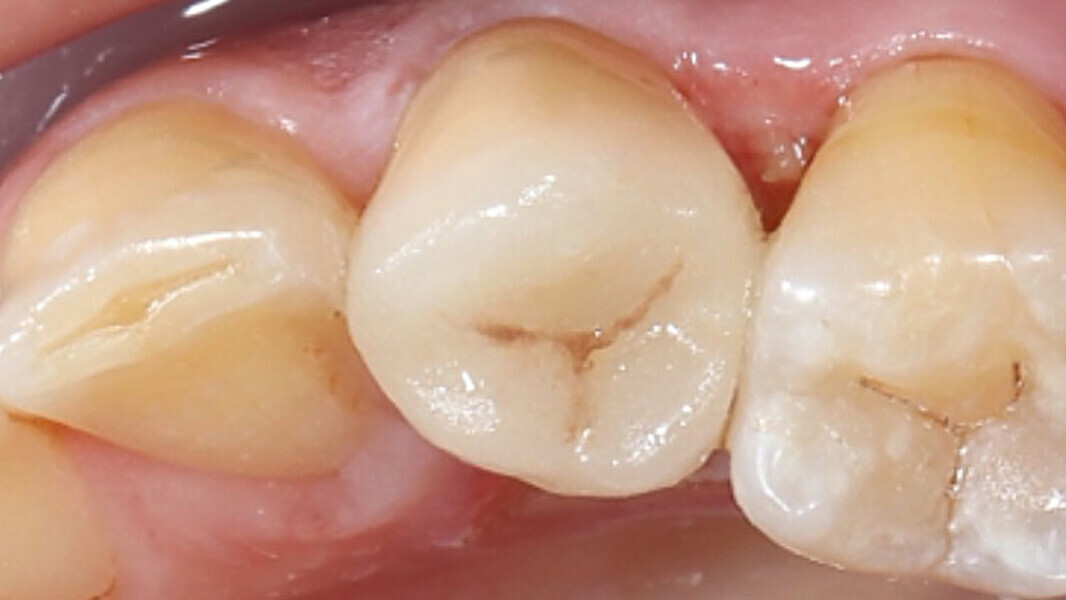 Fig. 13. Vista oclusal de la endocorona colocada de forma totalmente adhesiva.