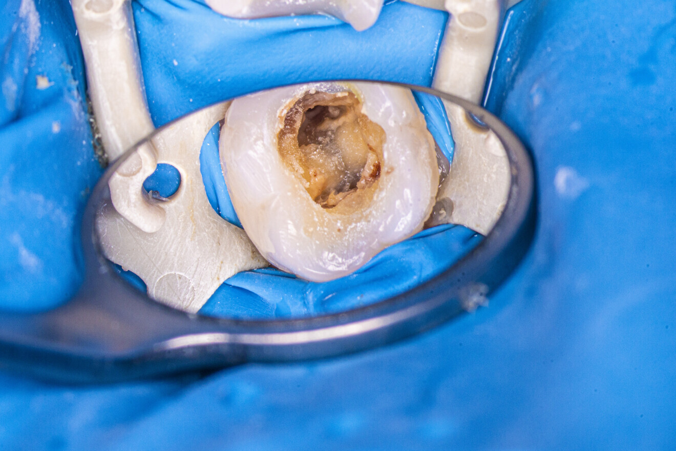 Fig. 5: Tooth after removal of the temporary restoration.