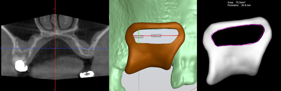 Fig. 3 - La posizione degli impianti viene pianificata sulla scansione CBCT. La progettazione include il disegno di una dima chirurgica che include la guida per disegnare l’antrostomia in accordo con i principi della tecnica Low Window. 