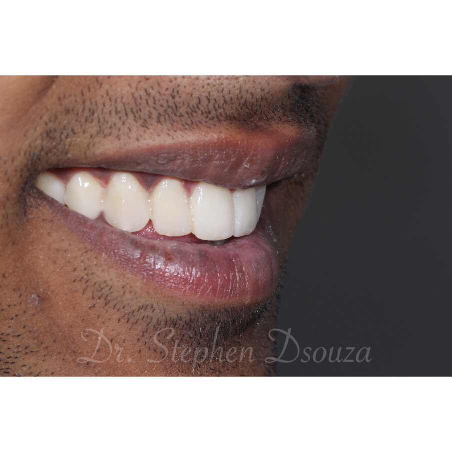Fig. 10 Postoperative smile oblique view