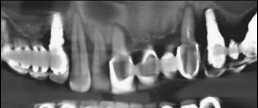 Fig. 2_La CBCT mostra la ridotta altezza della cresta ossea e la condizione dei seni mascellari.