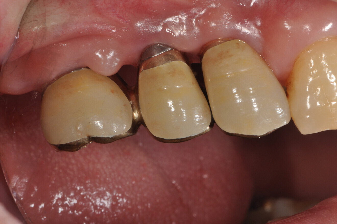 Gingival swelling and edema around an implant.