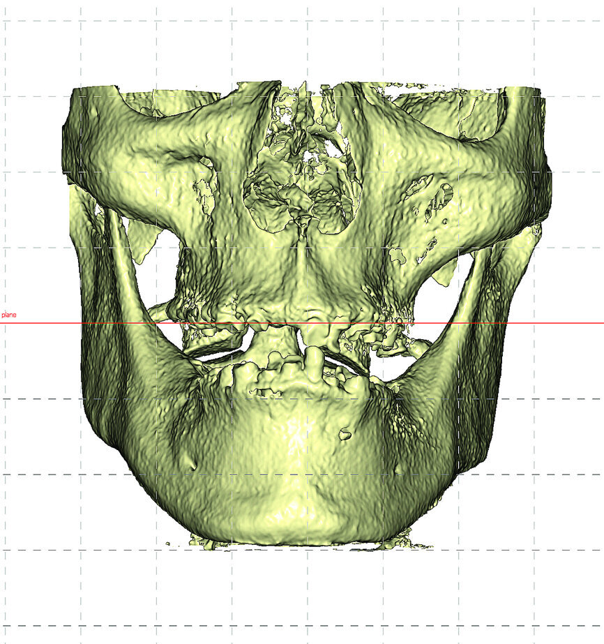 Fig. 2: Frontal view of reconstructed volume from CBCT dataset allows for total inspection of the patient’s anatomy.