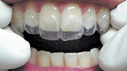 Estética y blanqueamiento dental en la era digital  (Capítulo 4)