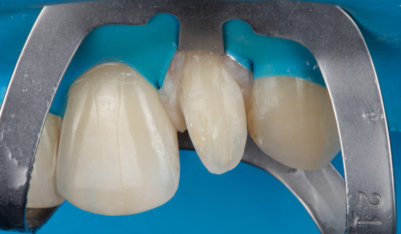 Fig. 3: Failing composite completely removed without compromising the tooth structure.