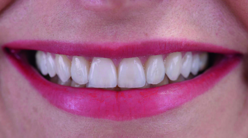 Fig. 17d : Large sourire.