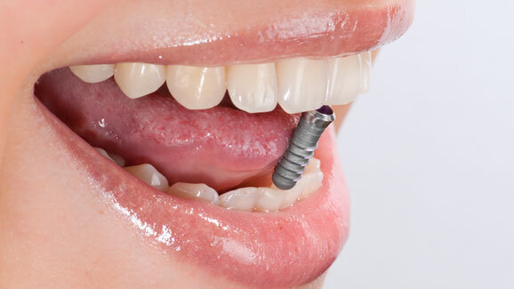 Studienvergleich: Implantate überzeugen