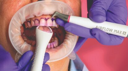 Guided Biofilm Therapy. Domande e risposte sulla soluzione sistematica per la gestione del biofilm