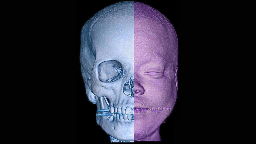 Pak Maxillofacial Surgeons Await International Recognition