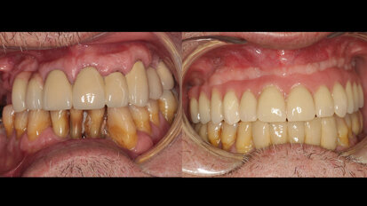 Tratamiento con “all-on-four” de paciente con dentición terminal