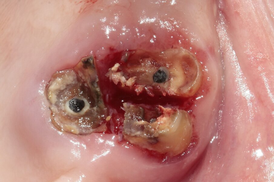 Fig. 2: The roots were separated to the correct depth. The tooth was divided into three parts to facilitate extraction. 