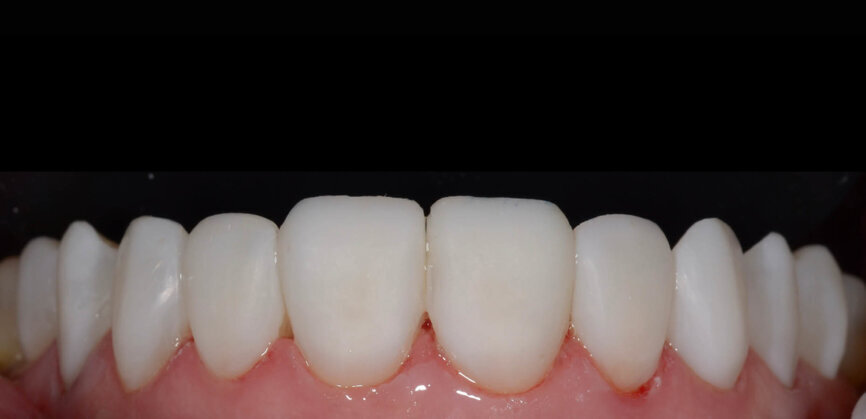 Fig. 12: Situation after restoring all of the teeth, before polishing. 
