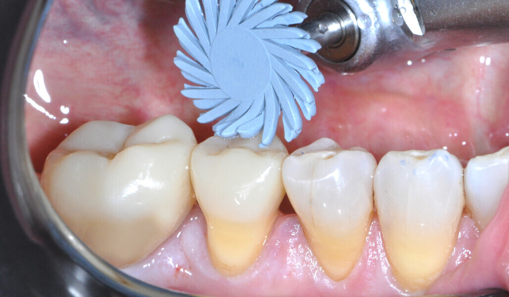 Fig. 27: Occlusal polishing. 