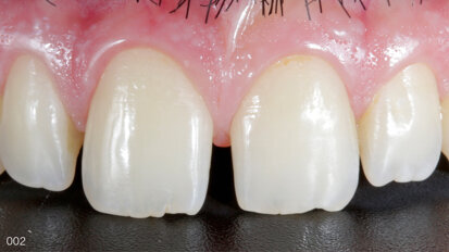 Extremely minimally invasive mock-up-guided veneer preparations in the aesthetic area