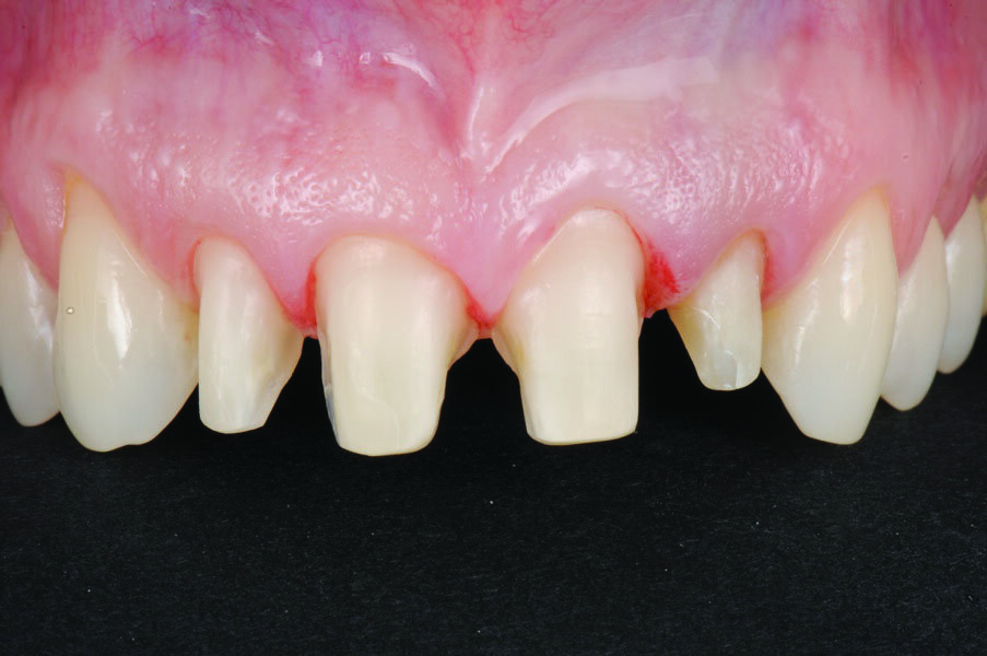 Fig. 2: Situation after tooth preparation.