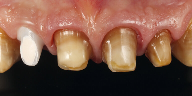 Fig. 23: The variation in the shade of the preparations made it necessary to use a relatively opaque material that nonetheless provided a certain brightening effect.