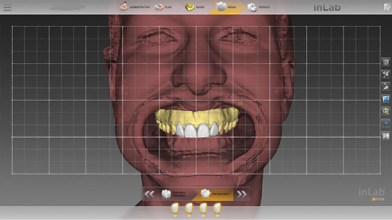 Highly esthetic results with CEREC® Primemill