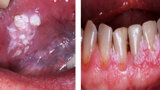Fig. 2. Verrugas. Lesión benigna que se localiza frecuentemente en lengua, paladar duro, paladar blando y labio, frecuente en niños y adolescentes.
