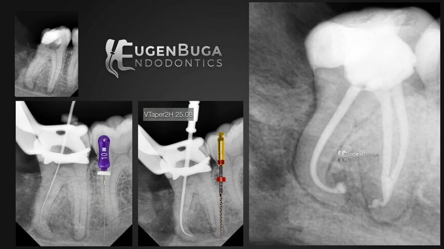 Conservative, fast and efficient management of a difficult mandibular molar case. (Image: Dr Eugen Buga)