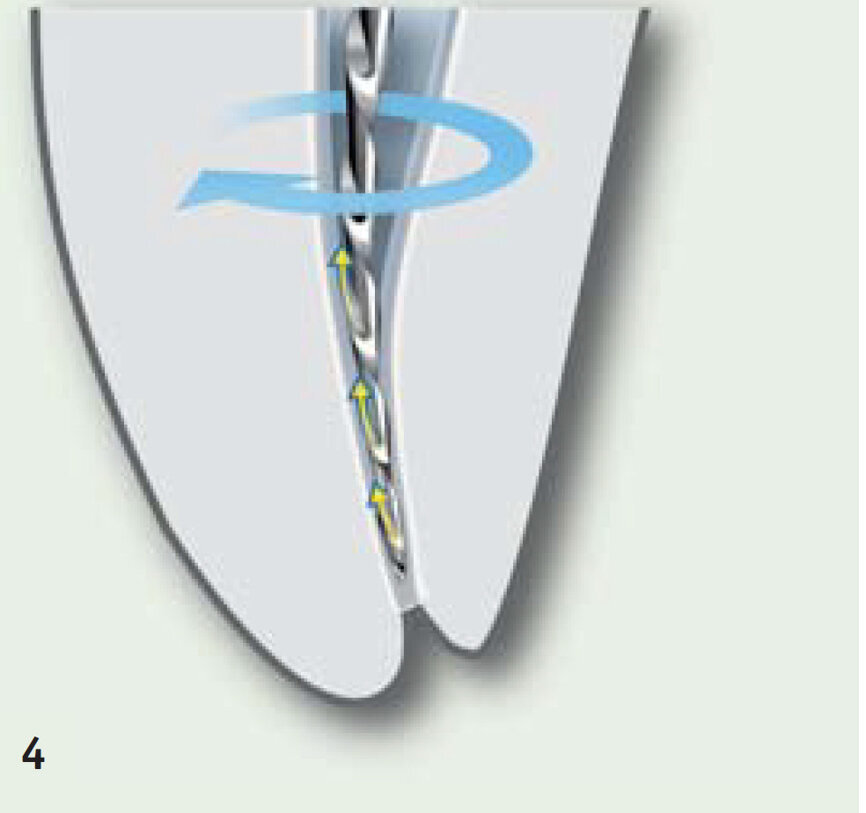 Fig. 4 : Rotation Continue (c Ultradent).