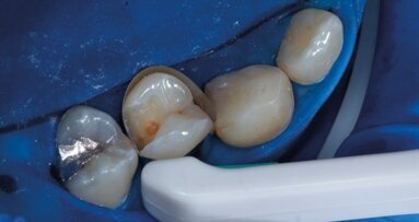 Case report. Restauro eseguito utilizzando le matrici Pro-Matrix e il composito Enamel Plus HRi