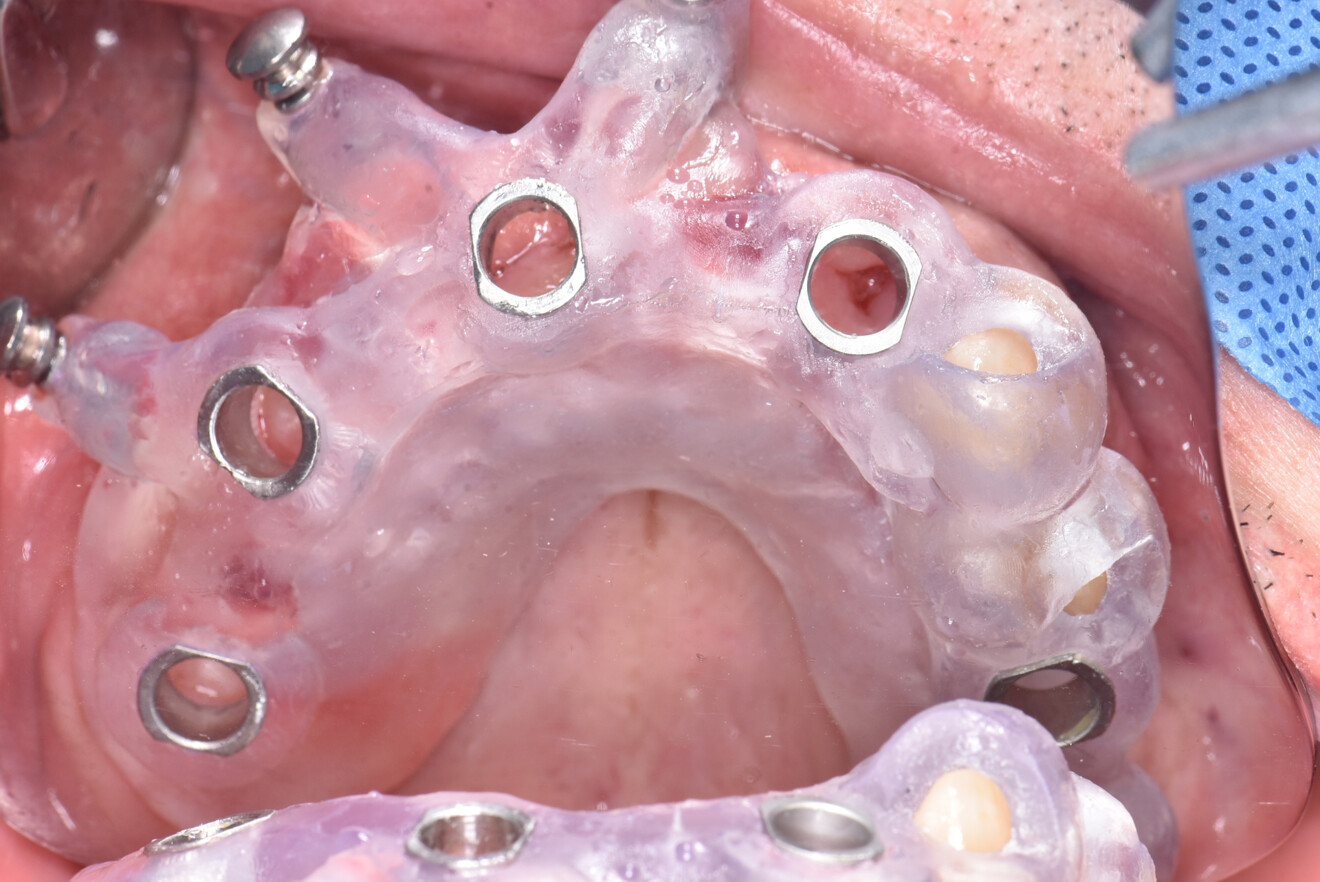 Fig. 3: 3D-printed surgical guide with metal sleeves shown intra-orally.