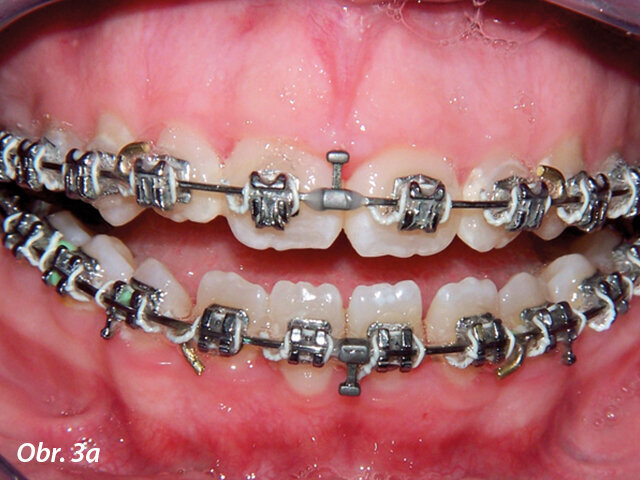 Gummy smile.