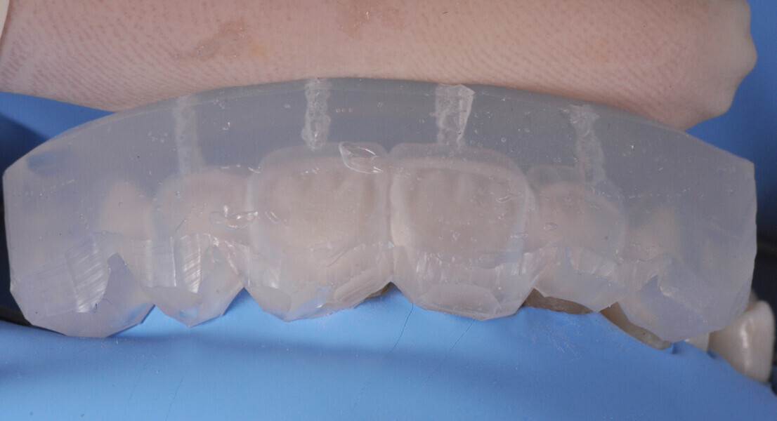 Fig. 16: Try-in of the transparent matrix for flowable injection.