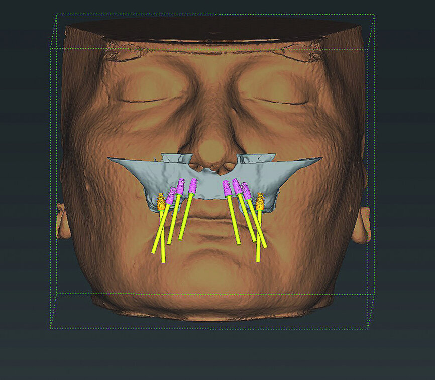Fig 5 Analyse dento-faciale du traitement implantaire proposé dans l’arcade maxillaire