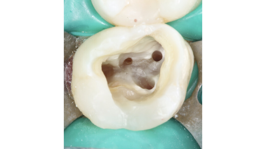 Fig. 4 : Système des canaux radiculaires mis en forme et nettoyé avant l’obturation.