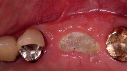 Procedure mininvasive d’aumento e preservazione alveolare (open barrier membrane technique)