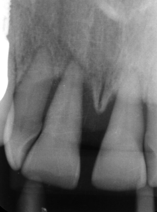 Fig. 4 - Endorale.