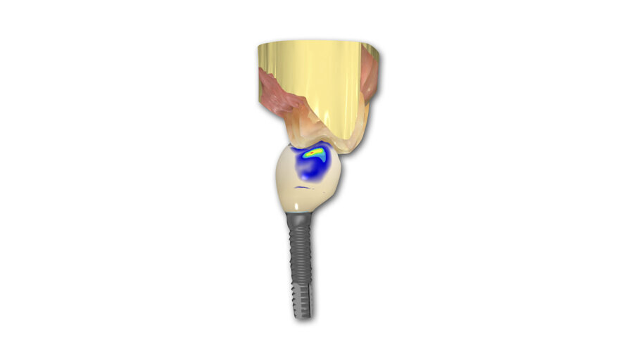 Fig. 2: The design of the crown has to be with a pseudo pontic, increasing the oblique load on the crown.