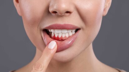 Gingivitis: Wie Mundgesundheit den Körper beeinflusst