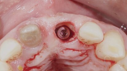 Consultant prosthodontist shares insight into the Socket-Shield Technique