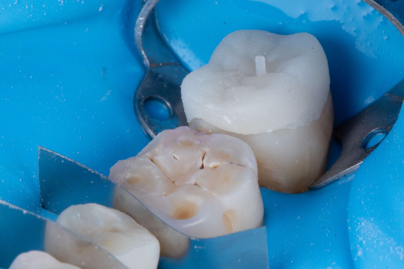 Fig. 6b: Isolamento dei denti prima della cementazione.