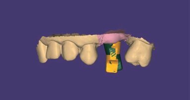 Il workflow digitale REX PiezoImplant nelle creste sottili