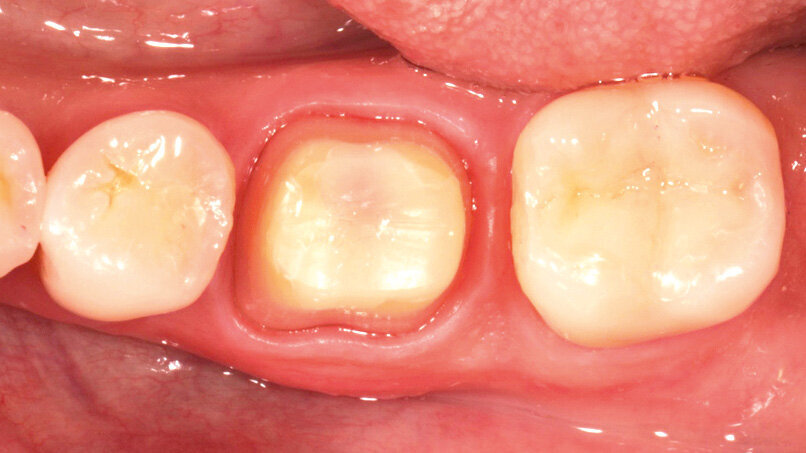 Fig. 5: One week after the preparation procedure, healthy soft tissue conditions are obtained. They lay the foundation for a high-quality precision impression.