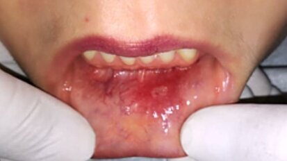 Tratamiento de afta bucal con ozonoterapia