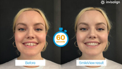 Align takes another step forward in the clear aligner industry