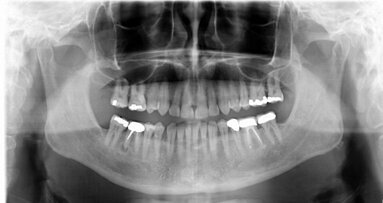 Kiedy leczyć, a kiedy podjąć decyzję o ekstrakcji – rola diagnostyki 3D w zwiększaniu skuteczności leczenia